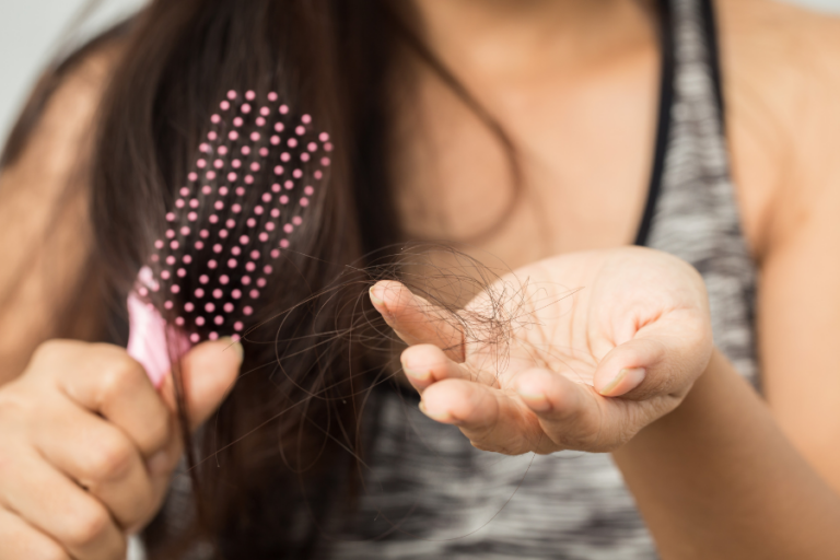 How to treat PCOS hair loss
